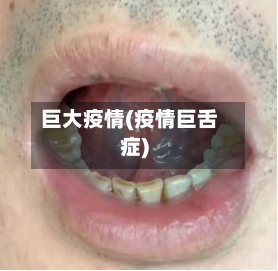 巨大疫情(疫情巨舌症)